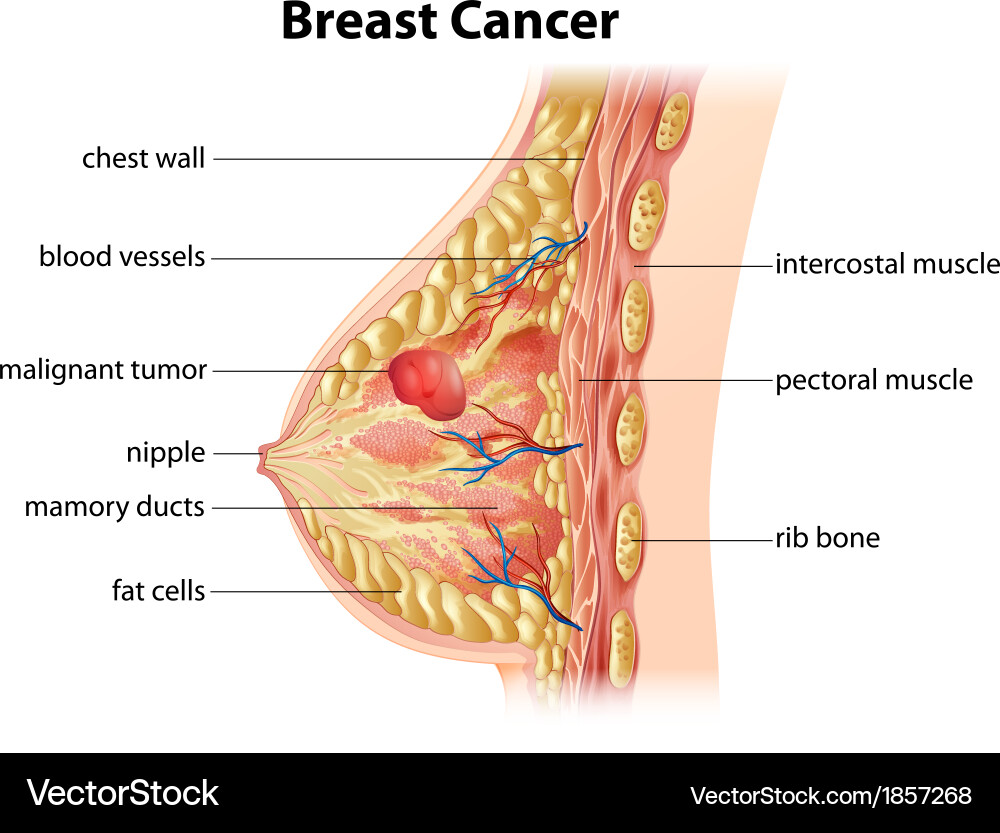Breast Cancer Awareness